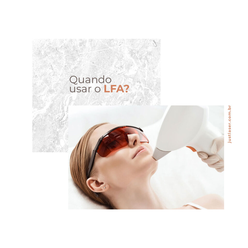 Quando usar o LFA? Aluguel de Lasers