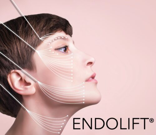 Endolift Process Como Aplicar O Endolift | Aluguel De Lasers