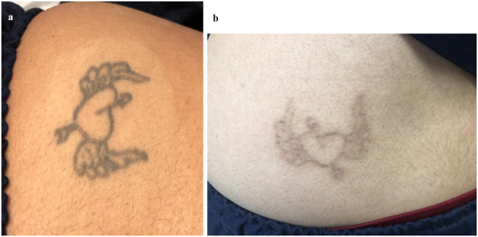 aluguel de laser para remoção de tatuagem Nd:YAG aluguel de laser para remoção de tatuagem Nd:YAG