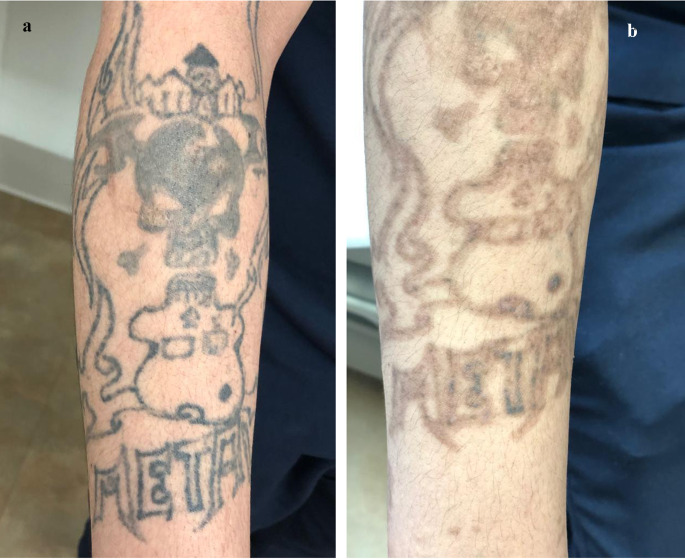 aluguel de laser para remoção de tatuagem Nd:YAG aluguel de laser para remoção de tatuagem Nd:YAG